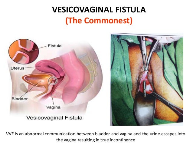 what are vaginal fistulas What are vaginal fistulas